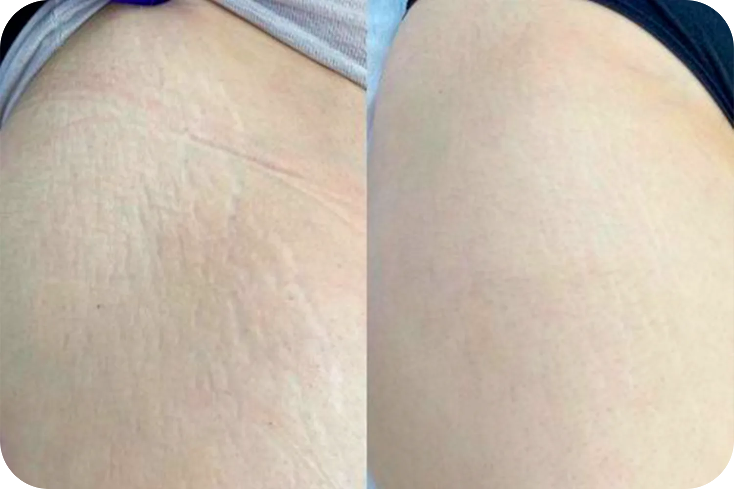 camuflaje-cicatriz-4