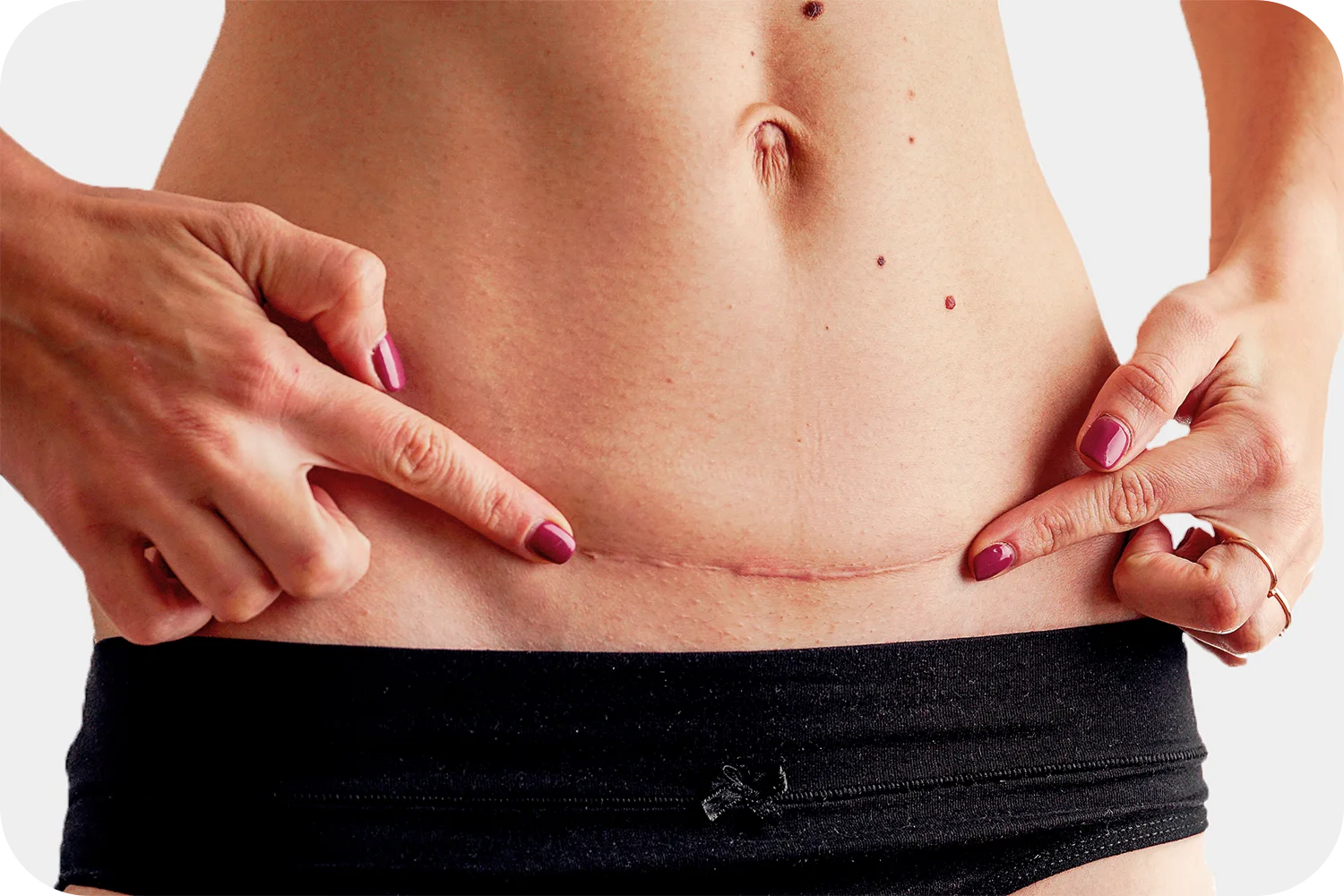 camuflaje-cicatriz-3