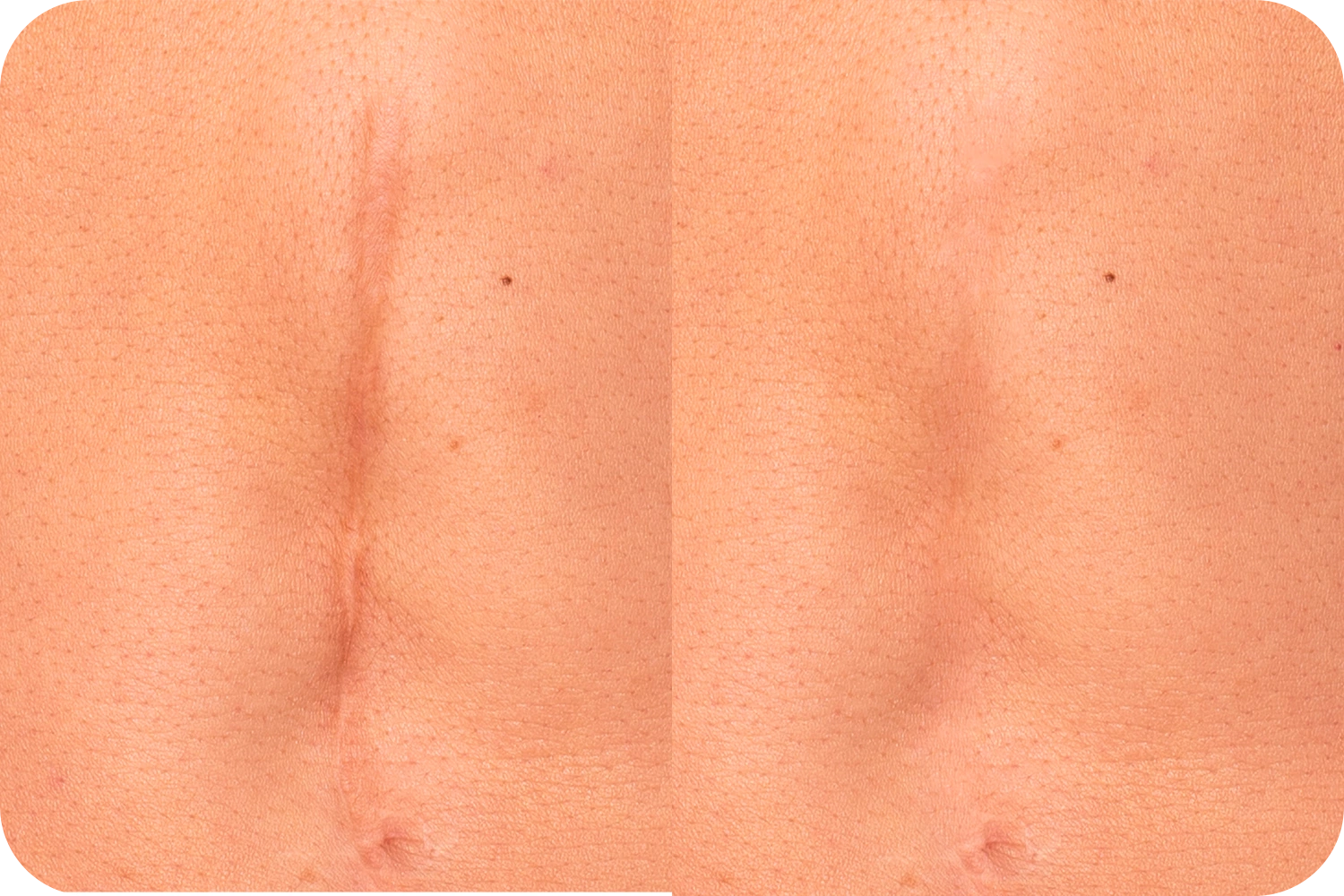 camuflaje-cicatriz-1