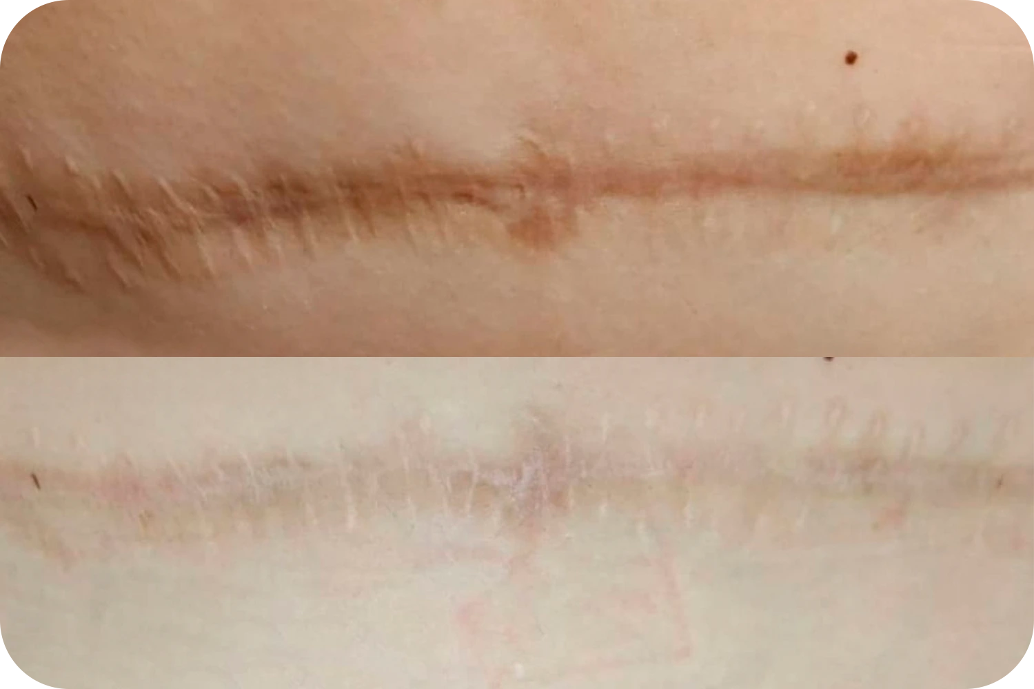 camuflaje-cicatriz-2